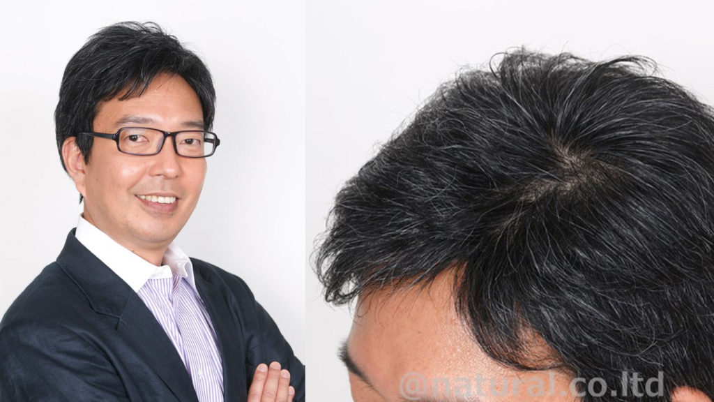 医療用ウィッグ男性の例