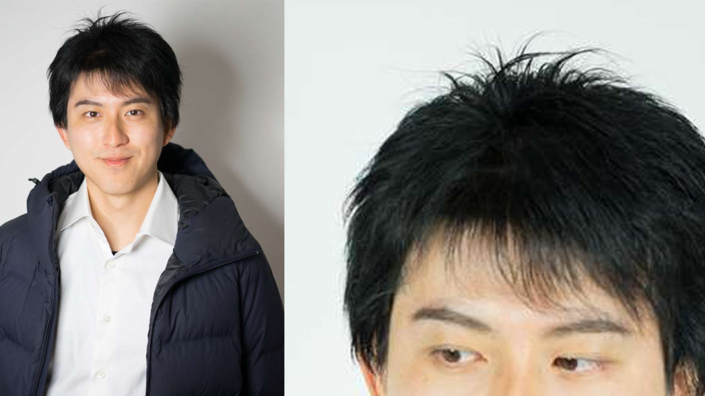 医療用ウィッグ男性の例