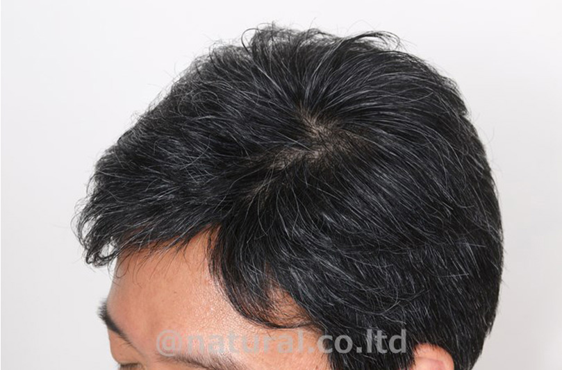 医療用ウィッグ　白髪入り