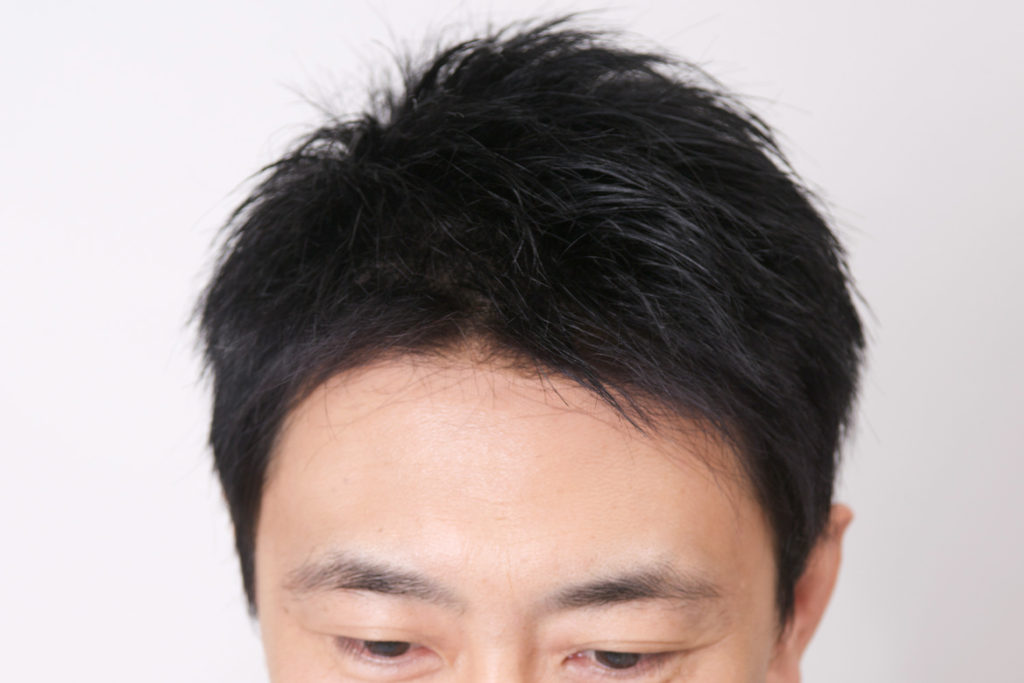 生え際写真